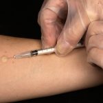 A tuberculin test being conducted. Credit: WikiImages/pixabay