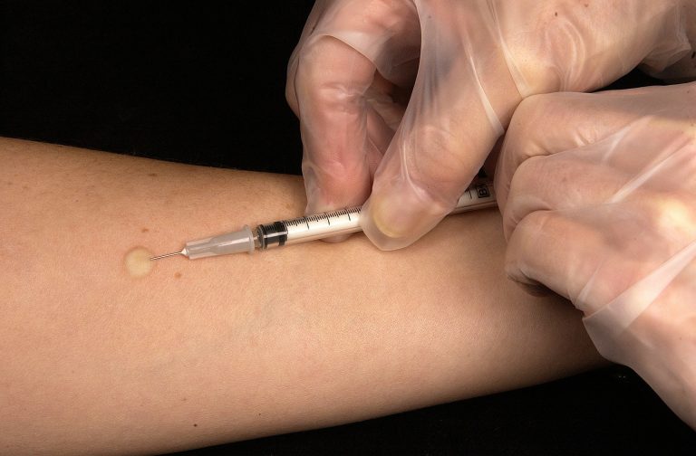 A tuberculin test being conducted. Credit: WikiImages/pixabay