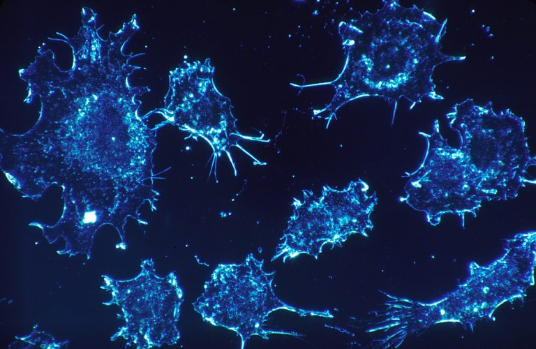 Cancer cells as seen under an electron microscope. Credit: skeeze/pixabay