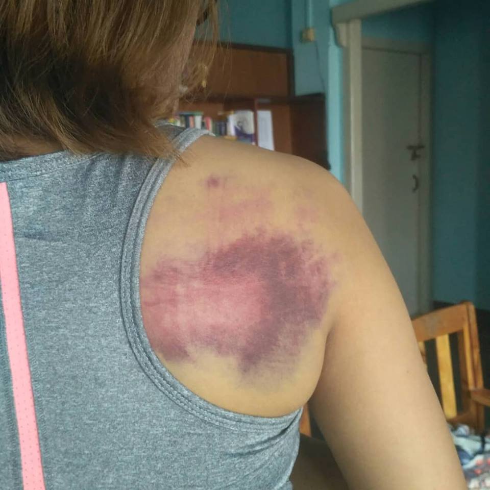 Emmy C. Lawbei shows her injuries in a Facebook post.