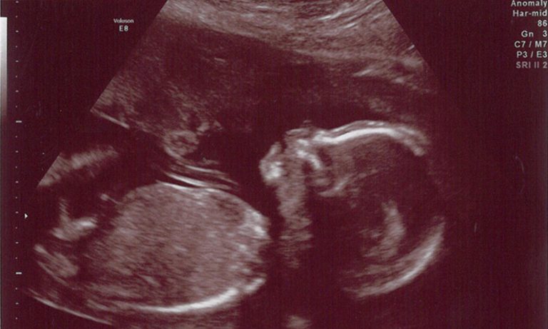 Should Women Really Consider Uterus Transplants?