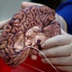 FILE PHOTO: A doctor holds a human brain in a brain bank in the Bronx borough of New York City, New York, US June 28, 2017. Credit: Reuters/Carlo