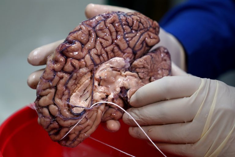 FILE PHOTO: A doctor holds a human brain in a brain bank in the Bronx borough of New York City, New York, US June 28, 2017. Credit: Reuters/Carlo
