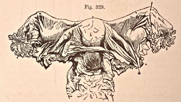 A medical illustration from 'Quain's Elements of Anatomy, Eighth Edition, Vol.II' (by William Sharpey MD, LLD, FRS L&E, Allen Thomson, MD, LLD, FRS L&E, and Edward Albert Schafer) depicts the anterior view of the uterus and its appendages, 1876. Credit: VintageMedStock/Getty Images via Undark.org