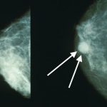 Breast cancer. Credit: Wikimedia Commons