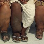 Haiti elephantasis