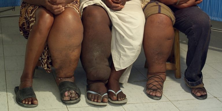 Haiti elephantasis