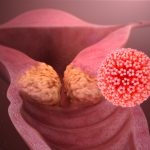 HPV is the most common virus that infects the reproductive tract and Cervical cancer is by far the most common disease caused by it. Caption and credit: Manu5/Wikimedia Commons, CC BY-SA 4.0