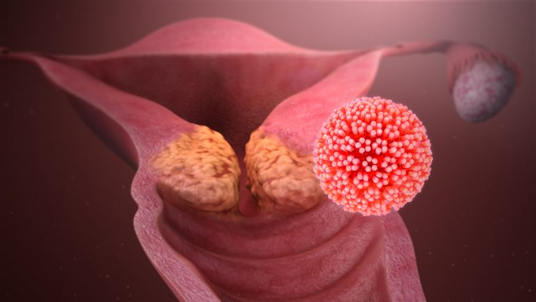 HPV is the most common virus that infects the reproductive tract and Cervical cancer is by far the most common disease caused by it. Caption and credit: Manu5/Wikimedia Commons, CC BY-SA 4.0