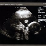pregnancy-ultrasound