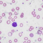 1280px-Iron_deficiency_anemia