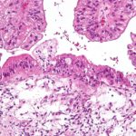 1280px-Mucinous_lmp_ovarian_tumour_intermed_mag