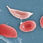 1911_Sickle_Cells