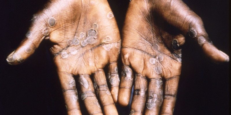 Interview: 'The World Should Have Acted During Past Monkeypox Outbreaks in Africa' - Vimarsana News