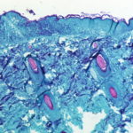 FILE PHOTO - A section of skin tissue, harvested from a lesion on the skin of a monkey, that had been infected with monkeypox virus