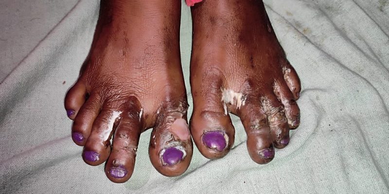 Brutally Attacked for Opposing Jat in Gram Panchayat Polls, Dalit Family Swears to Get Justice - Vimarsana News