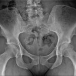 Calcified_uterine_fibroid,_1