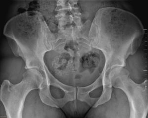 Calcified_uterine_fibroid,_1